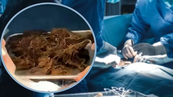 পেট থেকে বের হলো ২ কেজি ‘চুলের গোলা’